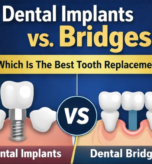 dental implants